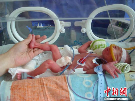 湖北宜昌"袖珍女婴"顽强存活 出生体重仅845克