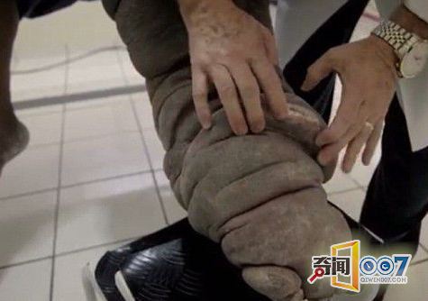象皮病的医学名称是淋巴丝虫病.